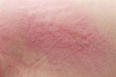 Cutaneous Candidiasis Causes Risk Factors Signs Symptoms Diagnosis