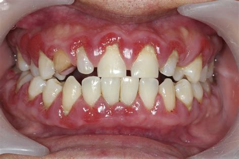Traitement De Gencives Parodontie Clinique Dentaire Agora