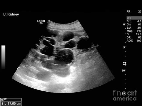 Polycystic Kidney Ultrasound Scan Photograph By Science Photo Library