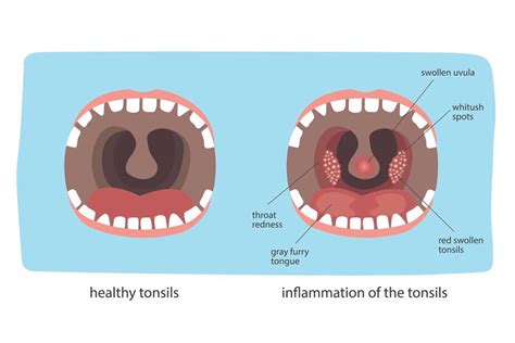 Strep Throat Causes Symptoms Post Oak Er No Wait 247