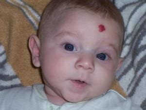 Maybe you would like to learn more about one of these? What is Strawberry Hemangioma Birthmark? Pictures, Causes ...