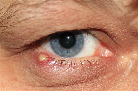 Eye Infections A Guide To Causes Symptoms And Treatment Magruder