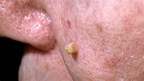 Can Rashes Be A Sign Of Cancer Itchiness And Symptoms
