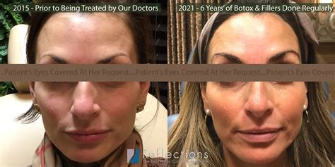 Botox And Fillers Long Term Effects Before And After Photos New Jersey