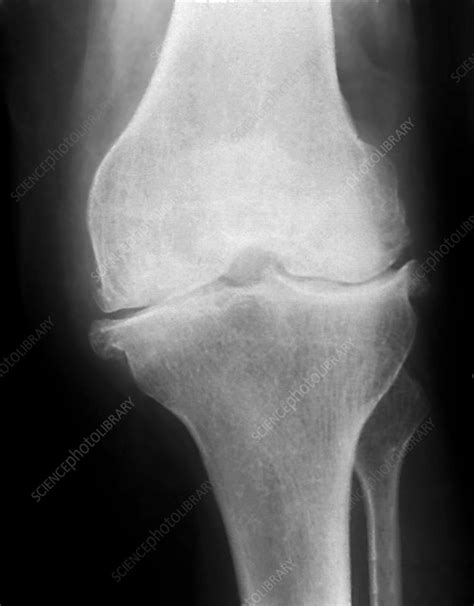 Osteoarthritis Of The Knee X Ray Stock Image C0468594 Science
