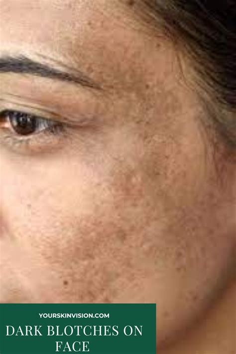 Dark Blotches On Face Causes Treatments And Remedies