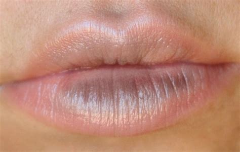 Purple Lips Symptoms Lipstutorial Org