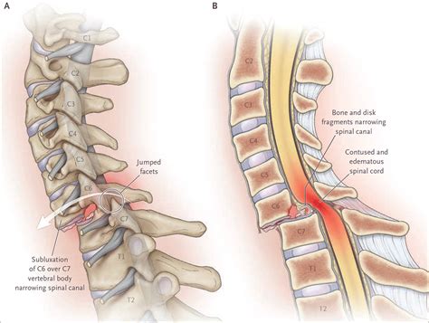 Acute Spinal Cord Compression Nejm Resident 360