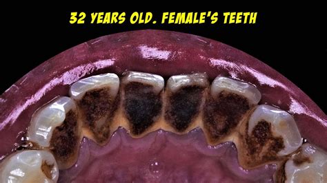 Black Tartar Smokers Teeth Dentist Dokter Gigi Tri Putra Youtube