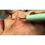 Age Spot Removal  YouTube