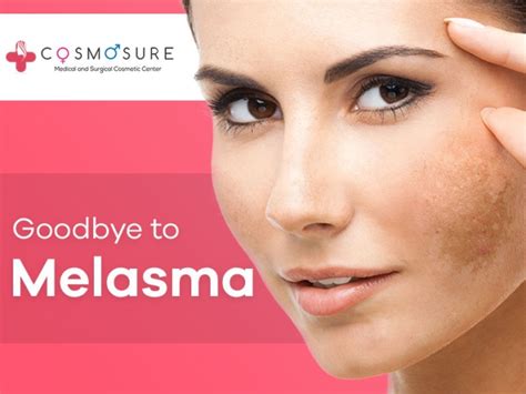 Melasma Treatment Overview Cosmosure Clinic