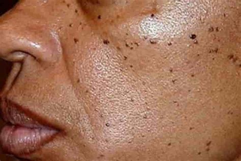 Tiny Black Dots On Skin