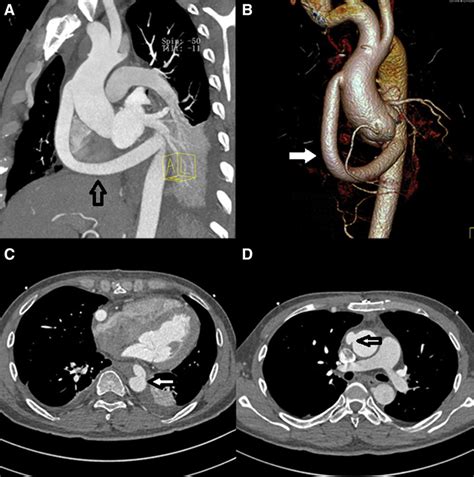 Rare Complex Coarctation Of Aorta Circulation Cardiovascular Imaging