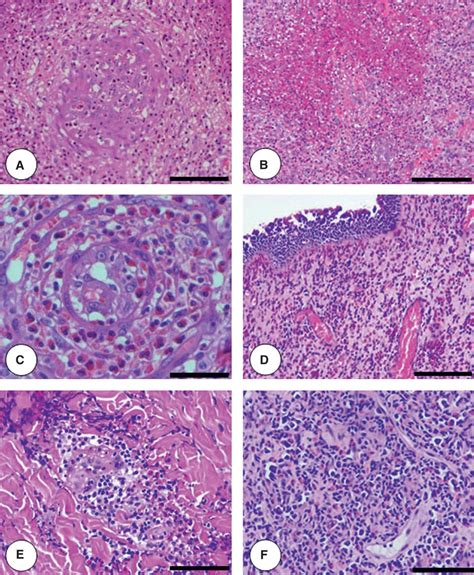 Eosinophilic Granulomatosis With Polyangiitis Churgstrauss State Of