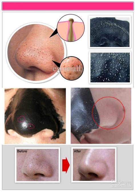 Depending on the area of hair removal, you may need about four to six treatments spaced four to eight weeks apart. Blackheads Removing Mask - AllDayChic