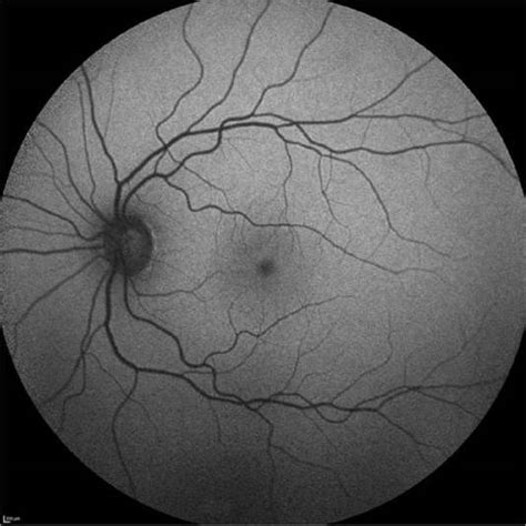 Imaging Modalities In Ophthalmology The Wills Eye Manual