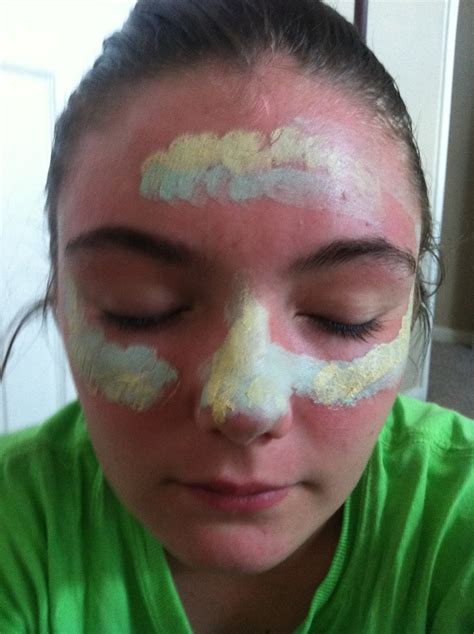 Life Of A Glitter Addict How To Cover Up Sunburn With Makeup