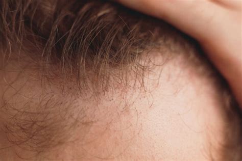 Why Do Men Go Bald Male Pattern Baldness Guide Dermaplast Aesthetic