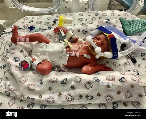 A Premature Baby Born At 30weeks And A Day Hours After Birth Stock