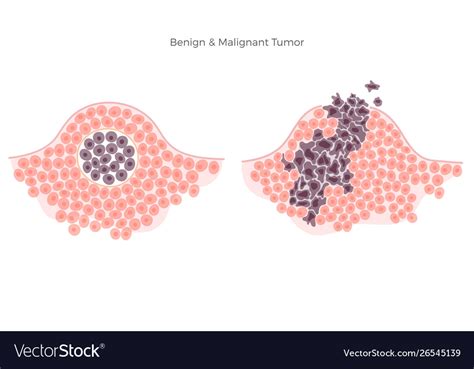 Malignant And Benign Tumor Royalty Free Vector Image