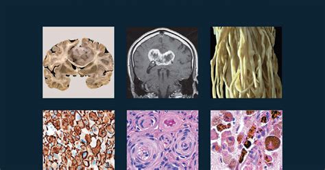 Neuropathology Blog Finally The New Who Cns Tumor Classification