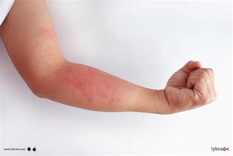 Eczema How You Can Prevent Its Flare Ups By Dr Nitin Jain Lybrate