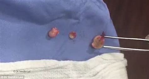 Dr Pimple Popper Drags Out Three Revolting Cysts From