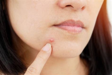 Accutane Isotretinoin Acne Medication Sl Aesthetic Clinic