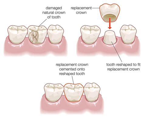 Dental Crowns Dental Esthetics Center