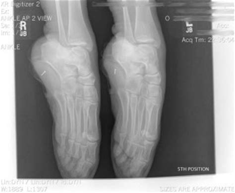 if you wanted to know what feet look like inside pointe shoes, well