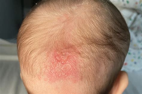Dermatita Seboreica Infantila Cauze Simptome Tratament Reginamaria Ro
