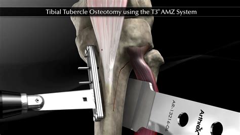 Arthrex Tibial Tubercle Osteotomy