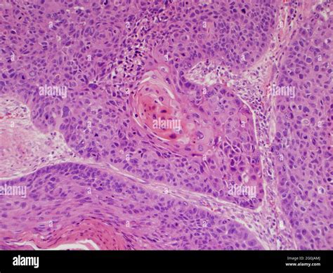 Celulas escamosas tumor fotografías e imágenes de alta resolución Alamy