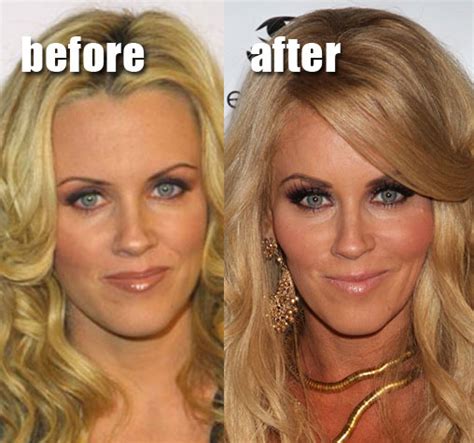 Funny Pictures Before And After Plastic Surgery Plastic