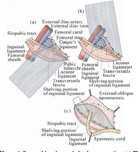 Figure 6 From Femoral Hernia A Review Of The Clinical Anatomy And Surgical Treatment Semantic