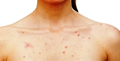 The Location Of Body Acne Heres What It Means About Your Health