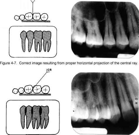 Central Ray Angulation Dental Radiography Global Healthcare