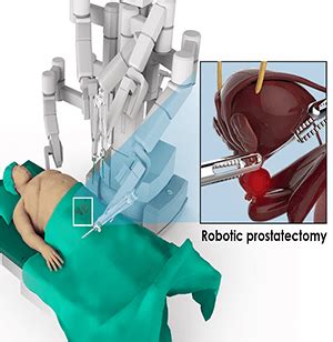 Robotic Prostatectomy Portland Robotic Assisted Laparoscopic Surgery