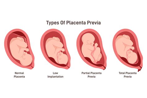 Placenta Previa Symptoms Causes And Treatment Being The Parent