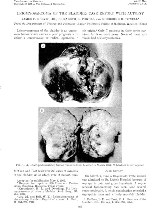 Leiomyosarcoma Of The Bladder Case Report With Autopsy Journal Of