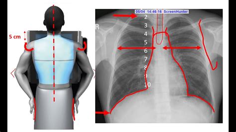 Dextrocardia with situs inversus is a condition that is characterized by abnormal positioning of the heart and other internal organs. Chest X-ray (PA) Technique and Positioning - YouTube