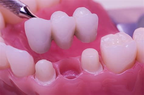 Fixed Partial Dentures Dental Bridges Dentist Says