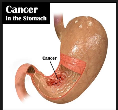 Look out for signs of cachexia (decrease in muscle mass). Welcome to our health magazine