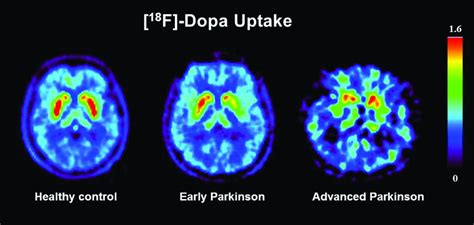 The Role Of Functional Dopamine Transporter Spect Imaging In
