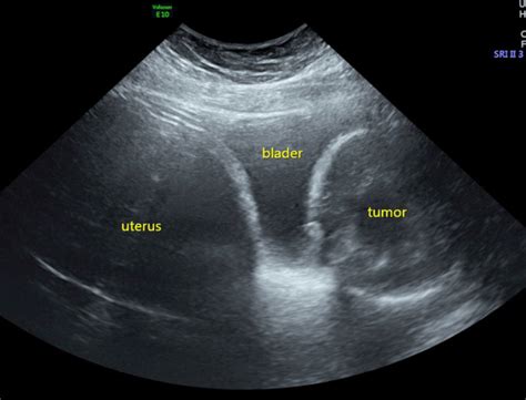 Ultrasonography Of The Pelvis Showing The Pelvic Organs And The