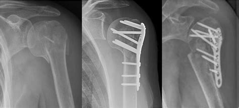 Proximal Humerus Fractures A Preoperatively B Status Post Open