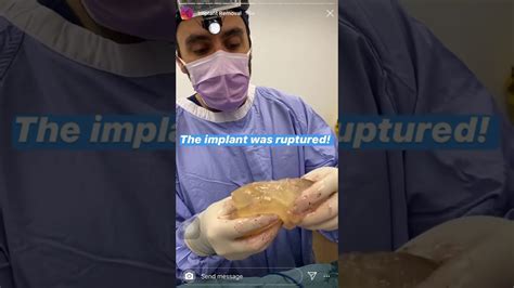 Breast Implant Removal Warning ⚠️ Graphic Footage To Follow Watch At