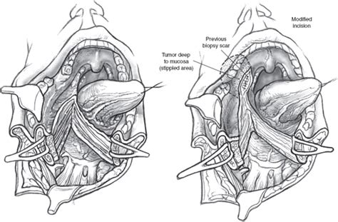 Atlas Of Salivary Gland Surgery Pocket Dentistry