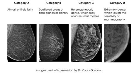 information about dense breasts