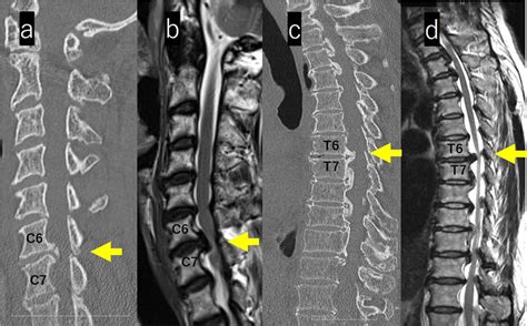 A D Mri And Ct Images Of The Cervical And Thoracic Spine Ct Images Of